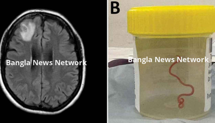 নারীর মগজে পাওয়া গেল জ্যান্ত কৃমি